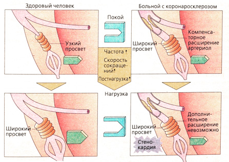 Б. Патогенез стенокардии напряжения при атеросклерозе коронарных артерий